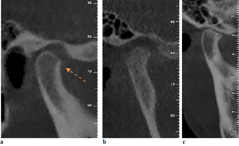 Cambios óseos en ATM evaluados con tomografía maxilofacial (cone beam)