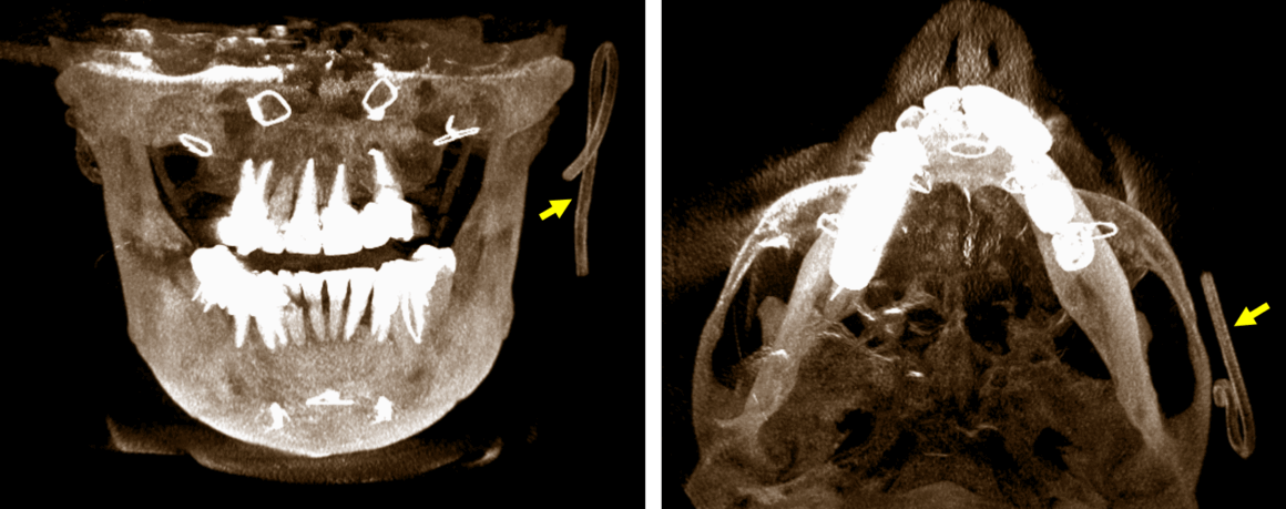 Detección de dispositivo inusual en la región maxilofacial