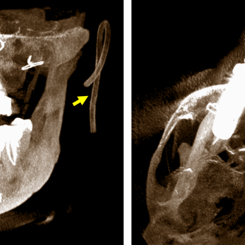 Detección de dispositivo inusual en la región maxilofacial