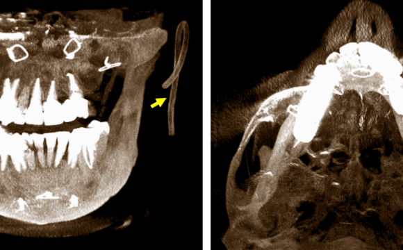 Detección de dispositivo inusual en la región maxilofacial