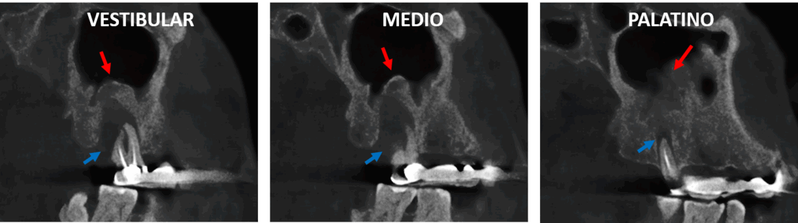 Osteoperiostitis Periapical afectando el seno maxilar evaluado con tomografía para implantes