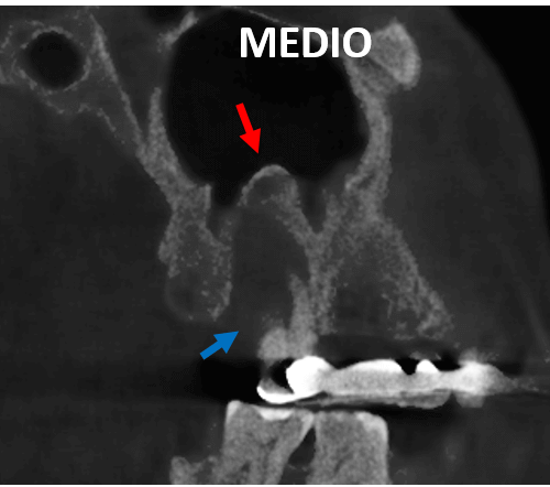 Osteoperiostitis Periapical afectando el seno maxilar evaluado con tomografía para implantes