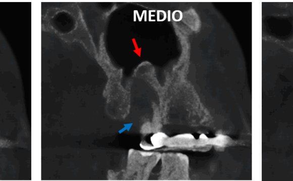 Osteoperiostitis Periapical afectando el seno maxilar evaluado con tomografía para implantes