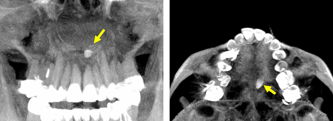 Mesiodens en zona inusual detectado por tomografía para dientes impactados