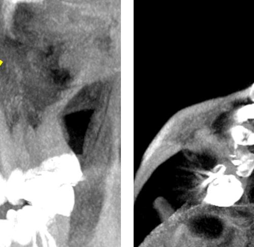 Mesiodens en zona inusual detectado por tomografía para dientes impactados