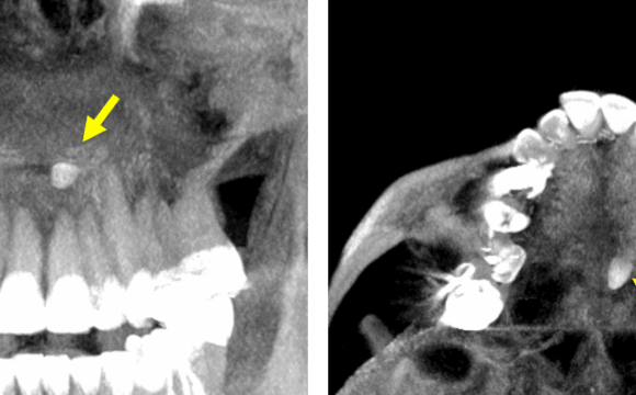 Mesiodens en zona inusual detectado por tomografía para dientes impactados