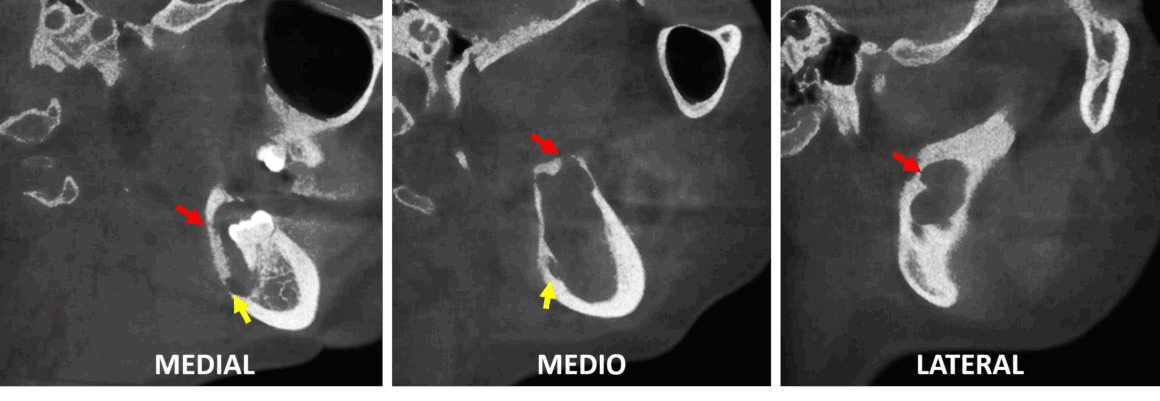Lesion osteolítica en la rama ascendente mandibular