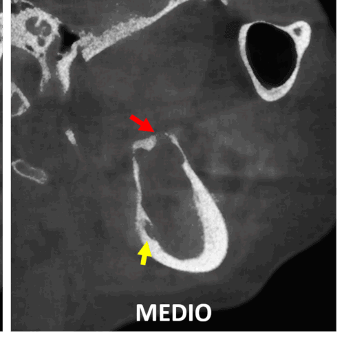 Lesion osteolítica en la rama ascendente mandibular