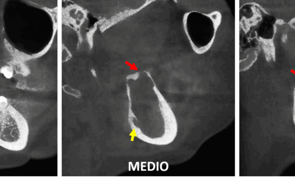 Lesion osteolítica en la rama ascendente mandibular