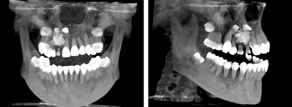 Múltiples odontomas compuesto en el maxilar superior evaluado con tomografía para ortodoncia