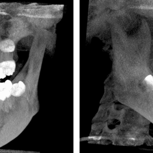 Múltiples odontomas compuesto en el maxilar superior evaluado con tomografía para ortodoncia