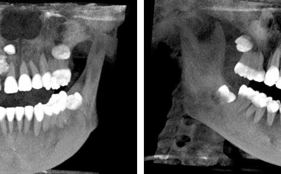 Múltiples odontomas compuesto en el maxilar superior evaluado con tomografía para ortodoncia