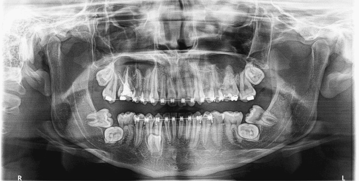 1 (2) Terceros molares inferiores en posición transversal evaluados con radiografía panorámica