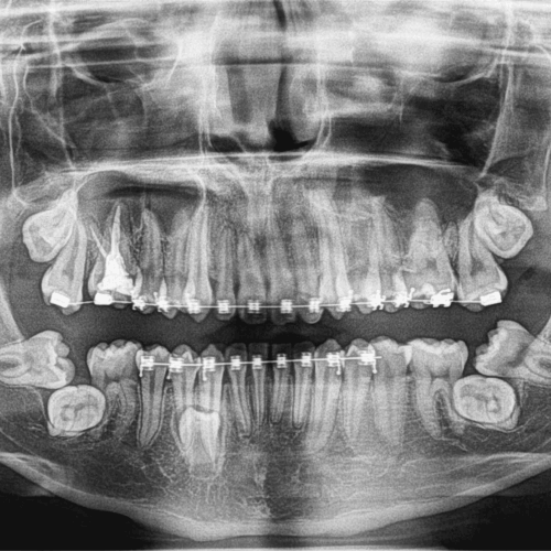 Terceros molares inferiores en posición transversal evaluados con radiografía panorámica