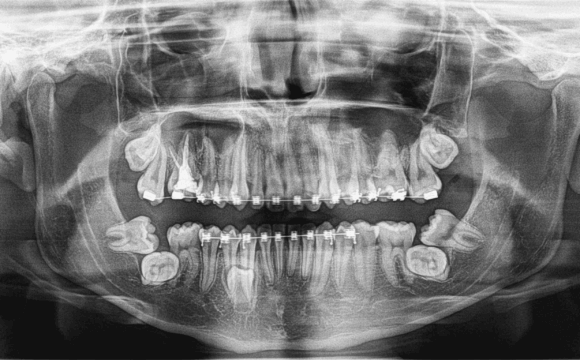 Terceros molares inferiores en posición transversal evaluados con radiografía panorámica