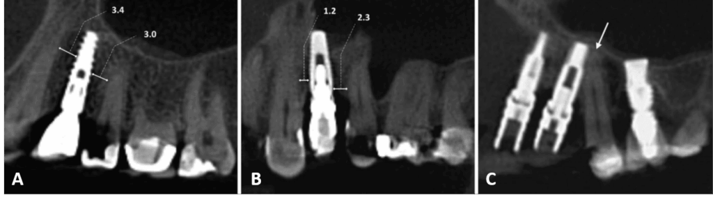 Errores de posicionamiento de implantes dentales en relación con estructuras anatómicas en el maxilar superior