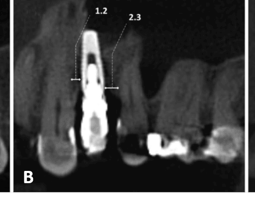 Errores de posicionamiento de implantes dentales en relación con estructuras anatómicas en el maxilar superior