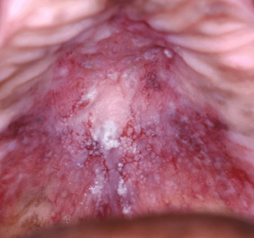 Lesiones blancas, rojas y mixtas en la mucosa oral