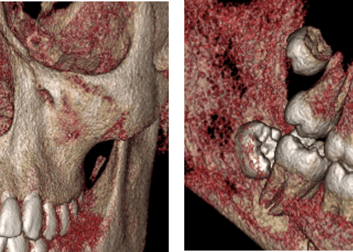 Mesiodens como causa de la impactacion dentaria evaluado por tomografía computarizada de haz cónico