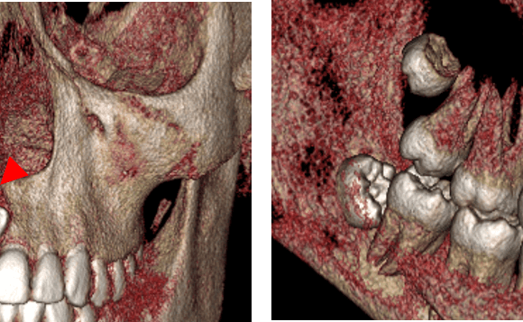 Mesiodens como causa de la impactacion dentaria evaluado por tomografía computarizada de haz cónico