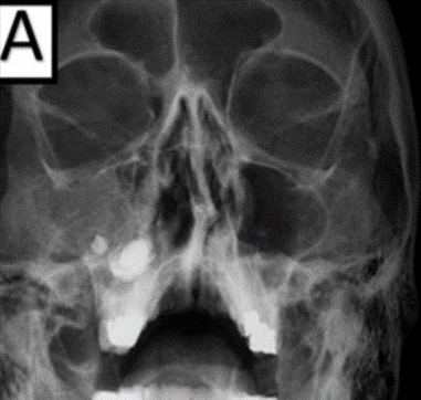 2 Sinusitis maxilar asociada a endodoncia