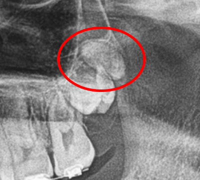 Distomolar en maxilar superior hallado en una radiografía panorámica