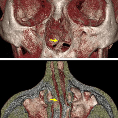 Desviación del tabique nasal como hallazgo en tomografía odontológica