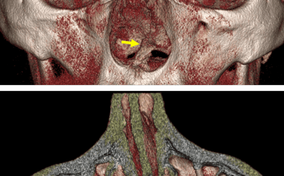Desviación del tabique nasal como hallazgo en tomografía odontológica