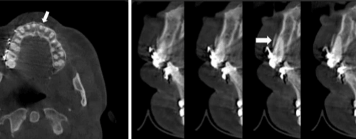 Tomografía de haz cónico para la evaluación de defectos óseos en odontología
