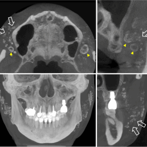Hallazgos tomográficos de rellenos cosméticos y su importancia en odontología