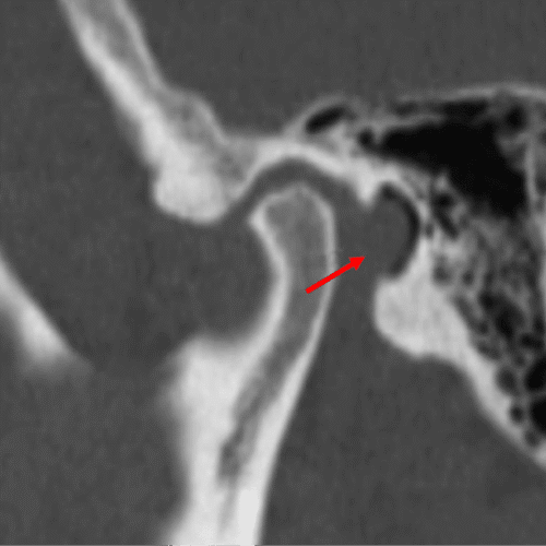Anomalías de la articulación temporomandibular