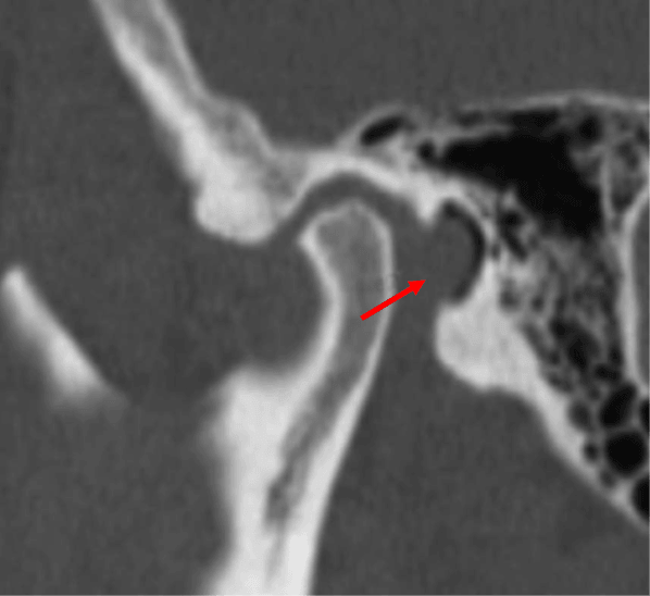 Anomalías de la articulación temporomandibular
