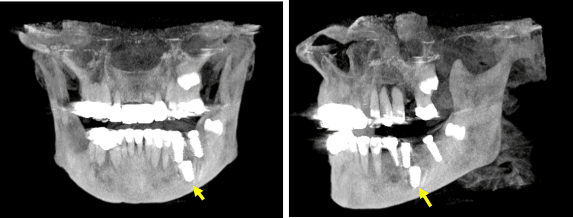 Implante dental en posición inusual en mandíbula