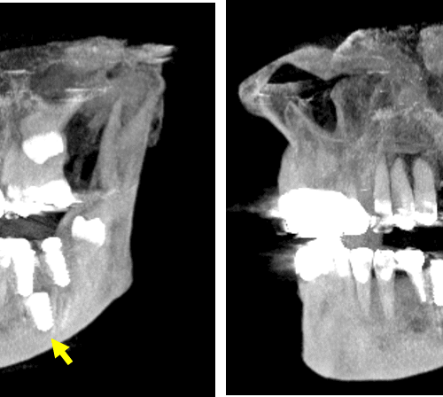 Implante dental en posición inusual en mandíbula