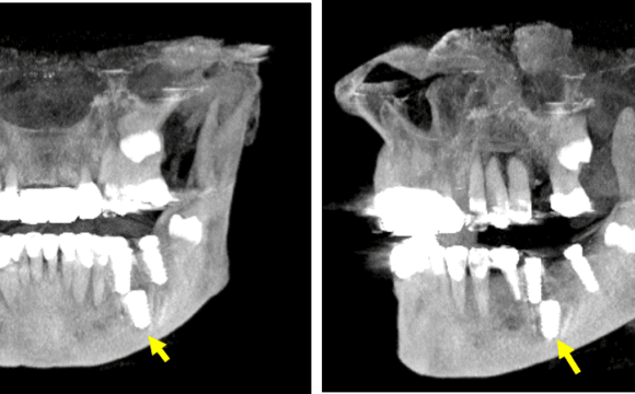 Implante dental en posición inusual en mandíbula