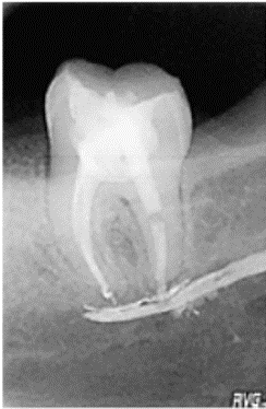 Sobreobturado de material de endodoncia