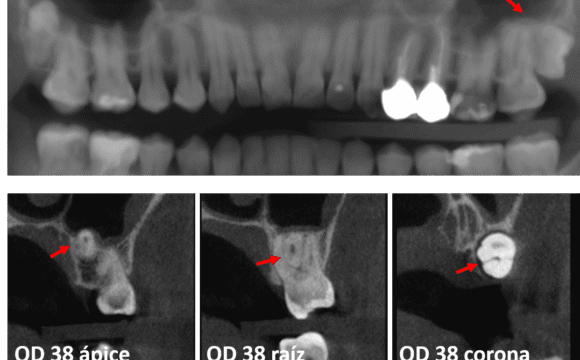 Tercer molar distoangular localizado entre las raíces del diente adyacente